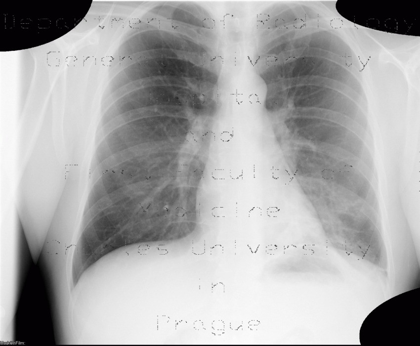 Bronchiectasis