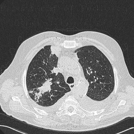 Bronchoinvasive aspergilosis