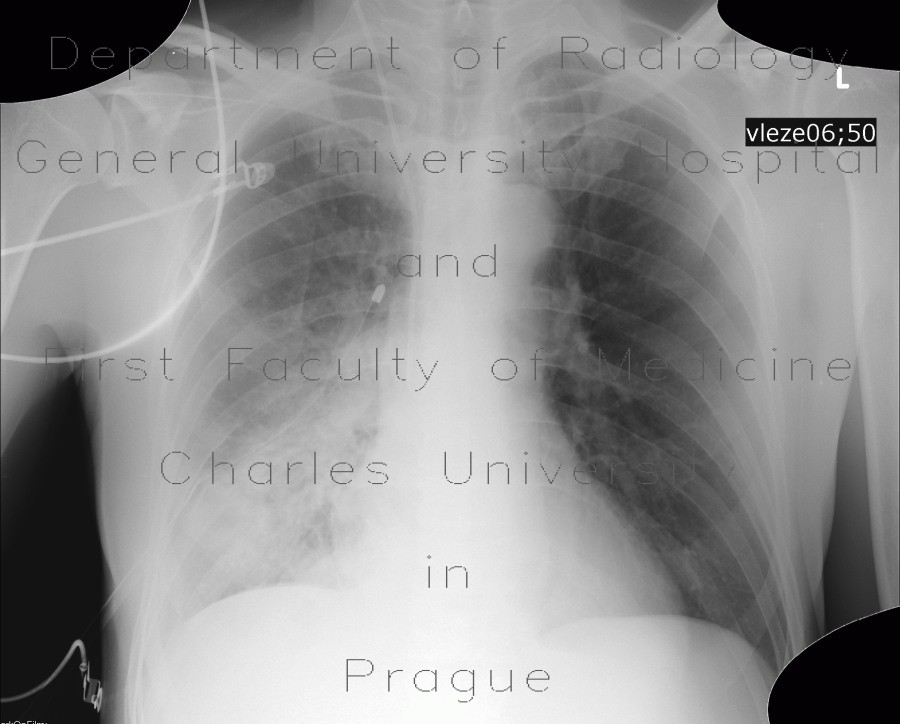Bronchopneumonia