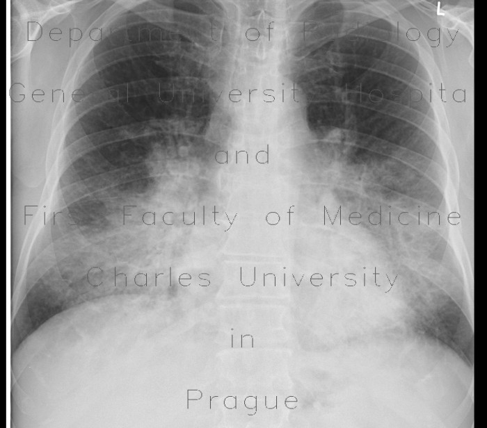 Bronchopneumonia, bilateral