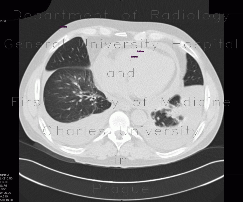 Bronchopneumonia, pleural effusion