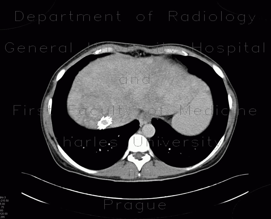 Budd-Chiari syndrome, thrombosis of hepatic veins, liver cirrhosis, TIPSS, splenomegally