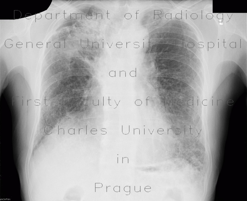 Bullous emphysema, lung tumour