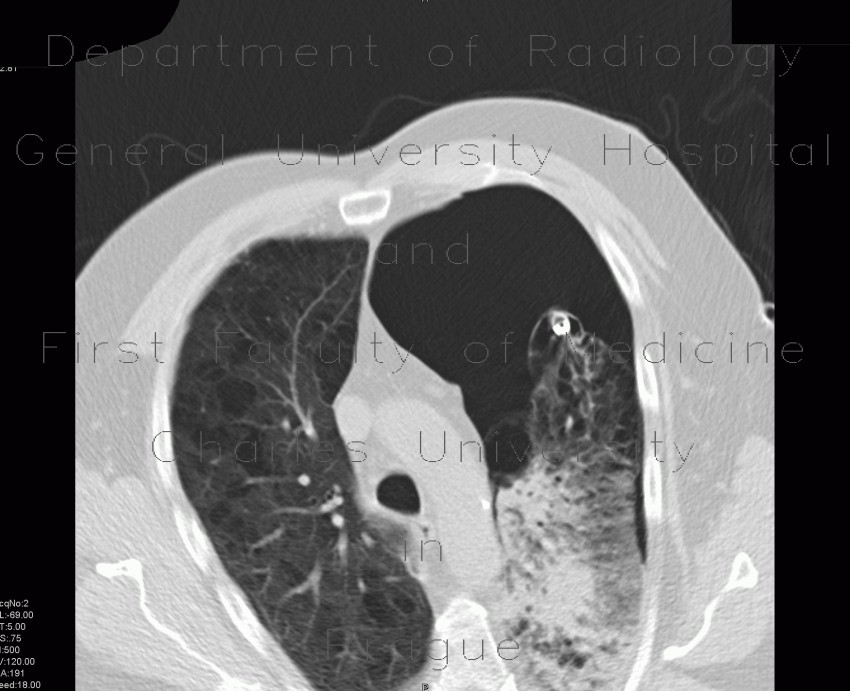 Bullous emphysema, pneumothorax