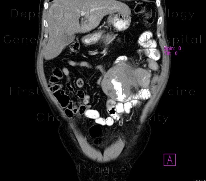 Burkitt's lymphoma of small bowel and liver
