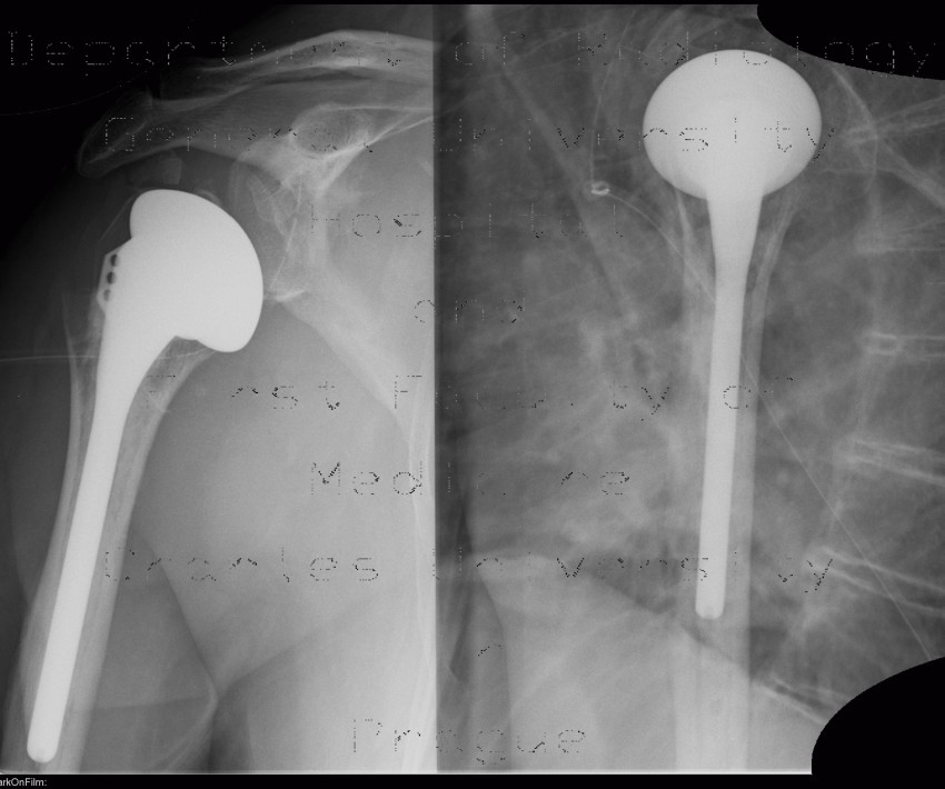 CCEP, shoulder joint, cervico-capital endoprosthesis