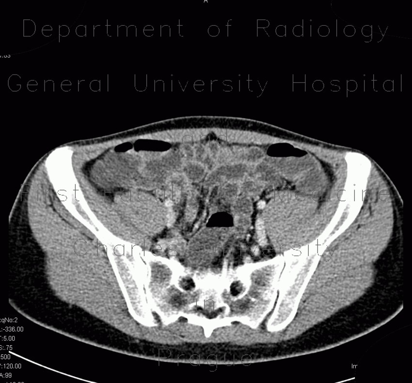 CT enterography, low-dose