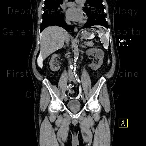 CT peritoneography