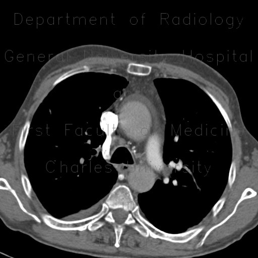 CTEPH, chronic thromboembolic disease, pulmonary hypertension, mosaic perfusion