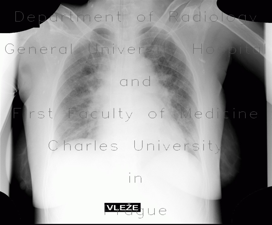 Calcification in lymph nodes in axilla, malposition of endotracheal tube, interstitial pulmonary edema