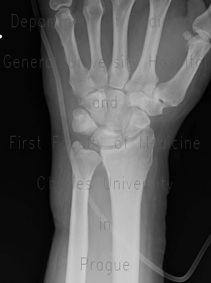 Calcification in triangular fibrocartilage complex, TFCC