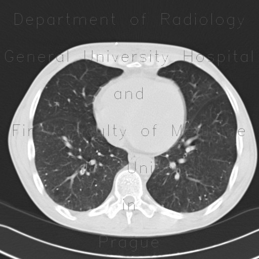 Calcifications in lung parenchyma, vasculitis