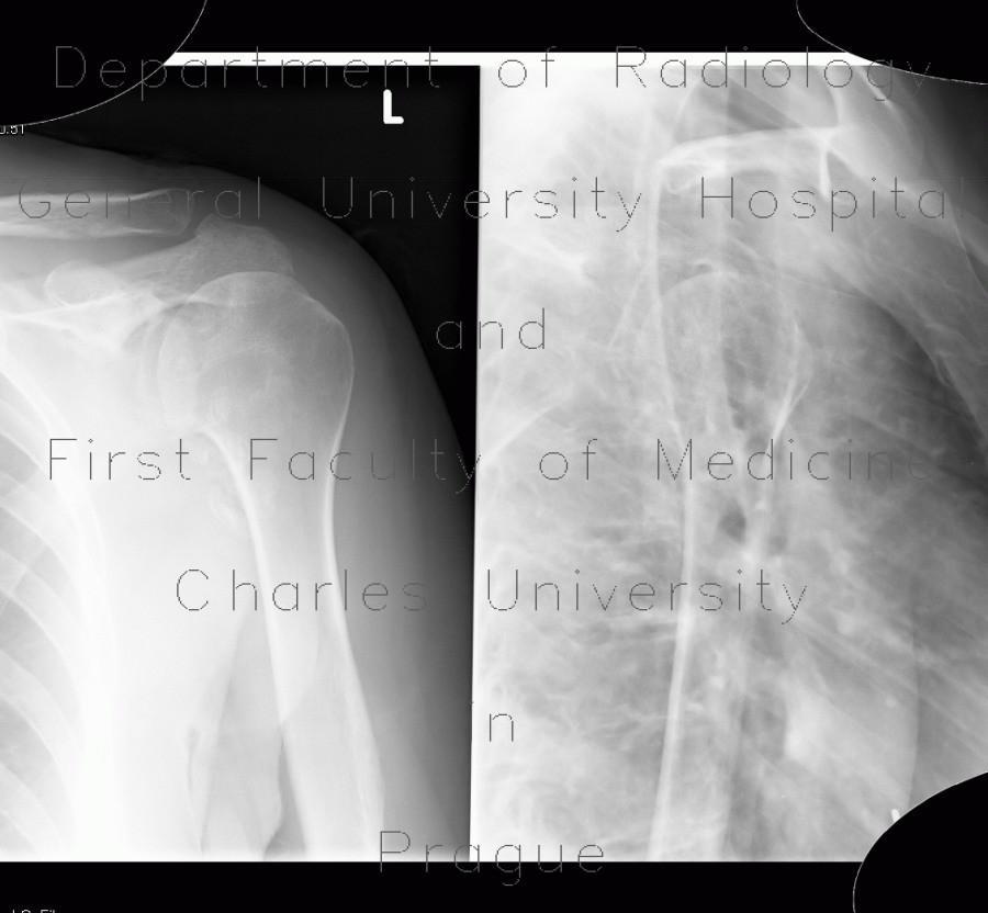 Calcified axillary lymph nodes