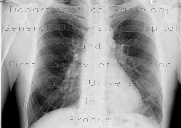 Calcified lymph node in lung hilum