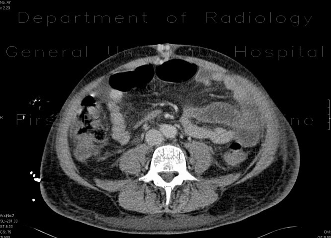 Caput medusae, porto-venous shunts, splenomegaly