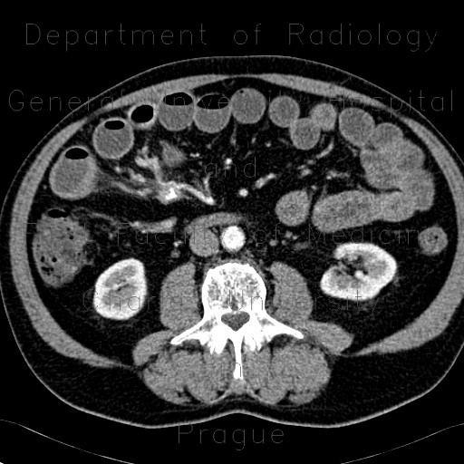Carcinoid of terminal ileum, mesentery, desmoplastic reaction, prestenotic dilatation