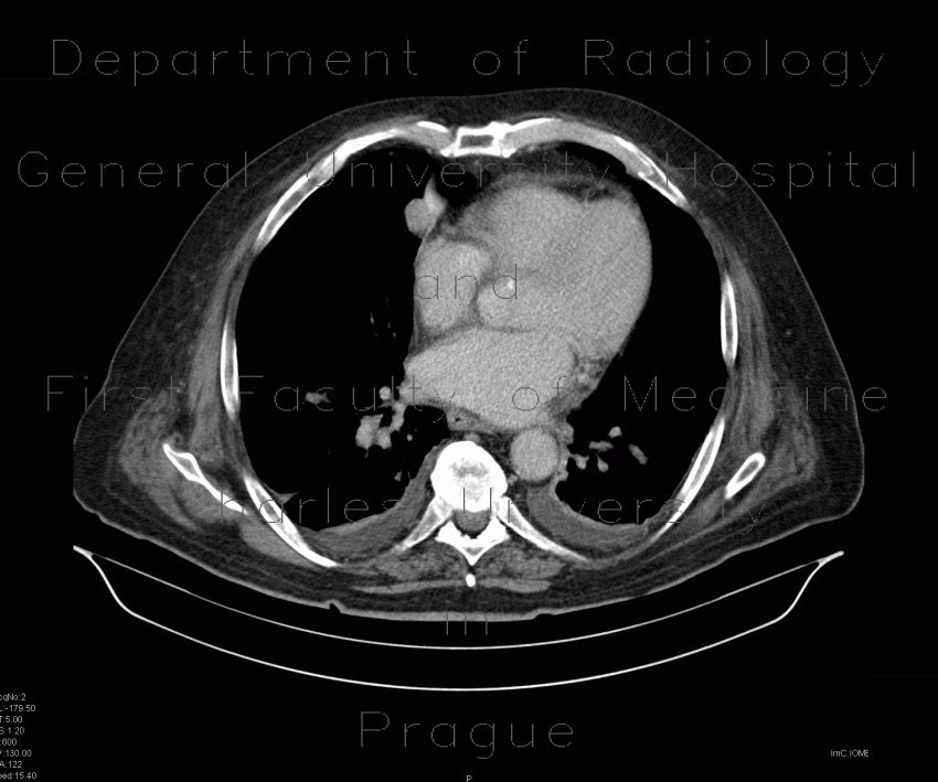 Carcinoid of the lung