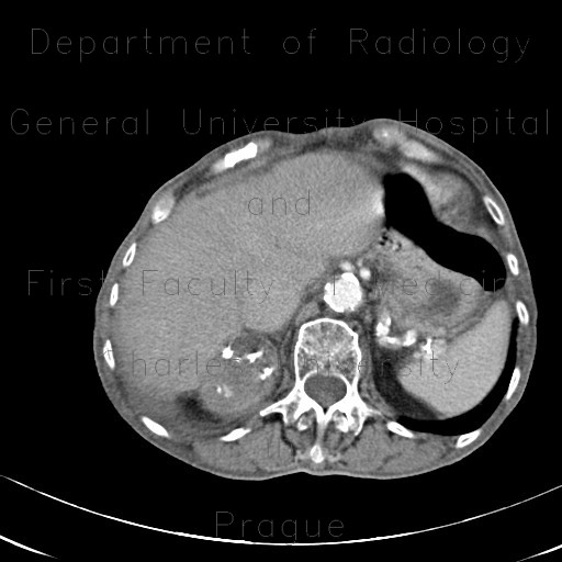 Carcinoma of adrenal gland, adrenal carcinoma