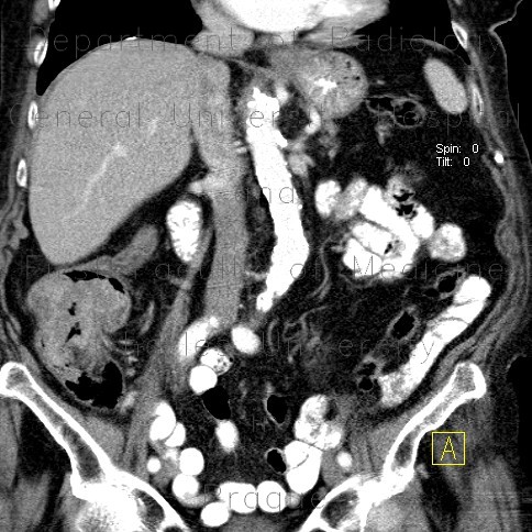 Carcinoma of ascending colon, colorectal carcinoma