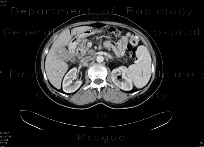Carcinoma of gallblader