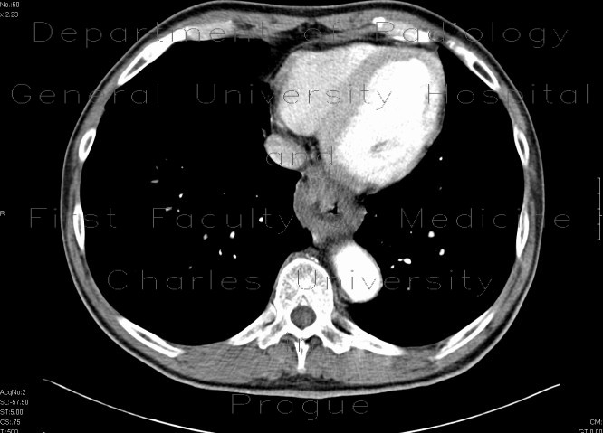 Carcinoma of oesophagus and cardia