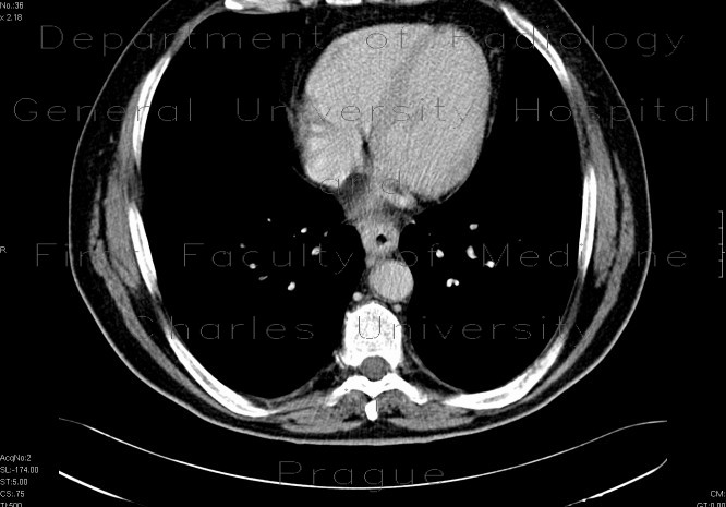 Carcinoma of oesophagus, tumorous stenosis