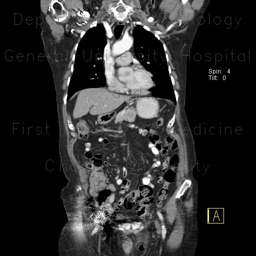 Carcinoma of pancreas