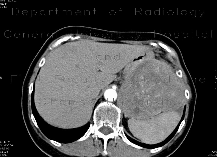 Carcinoma of pancreas, gigantic, liver metastases