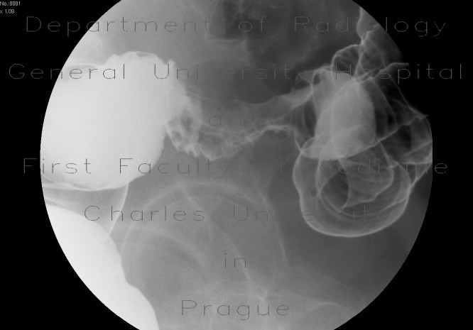 Carcinoma of sigmoid colon, barium enema