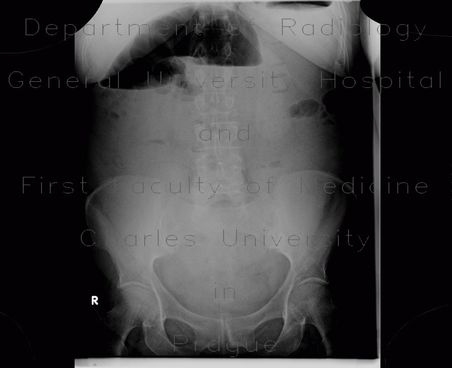 Carcinoma of sigmoid colon, large bowel obstruction, ileus
