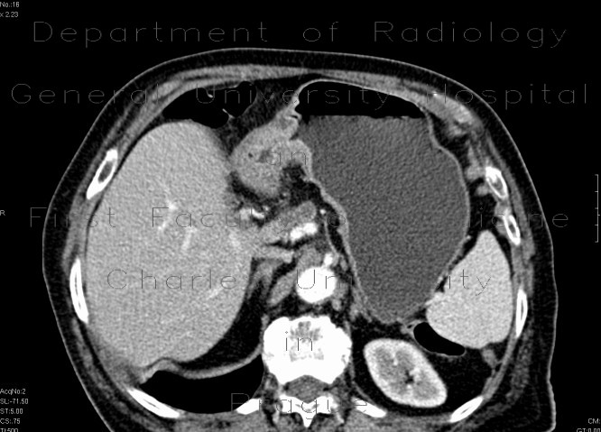 Carcinoma of stomach, antrum