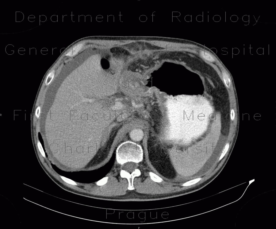 Carcinoma of stomach, scirrhotic carcinoma, infiltration of the wall