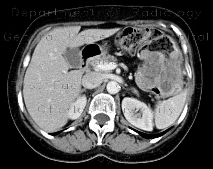 Carcinoma of the lienal flexure
