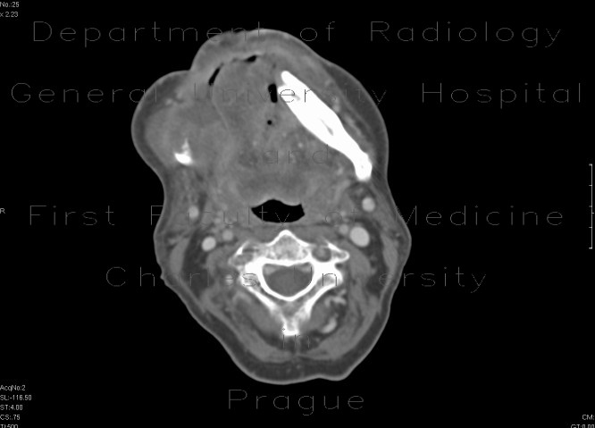 Carcinoma of the mouth floor and tongue