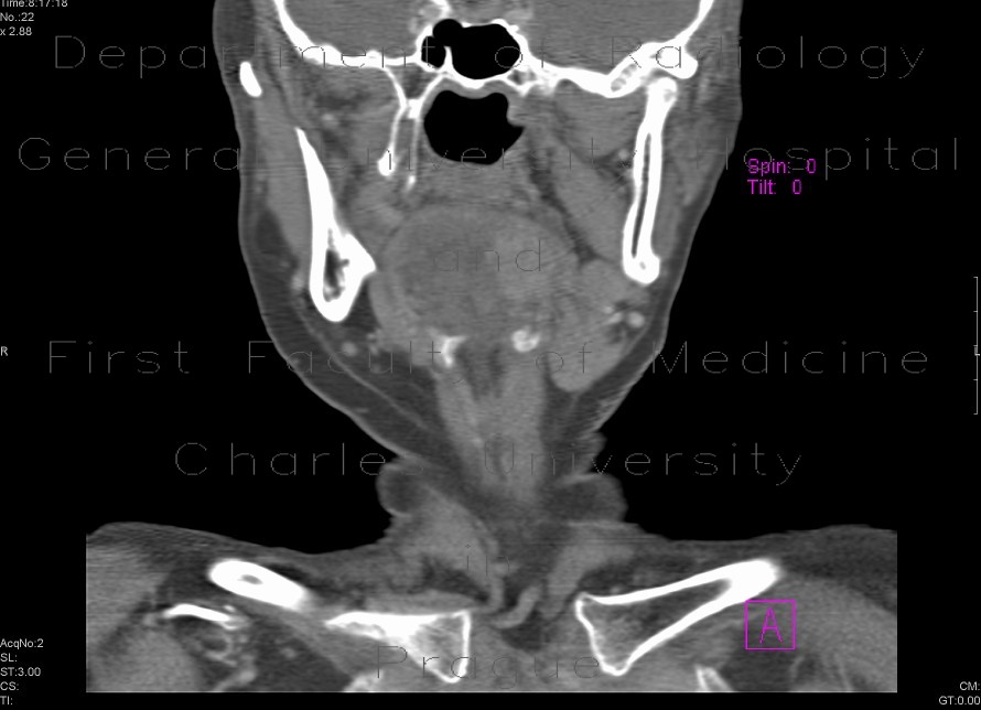Carcinoma of the tongue