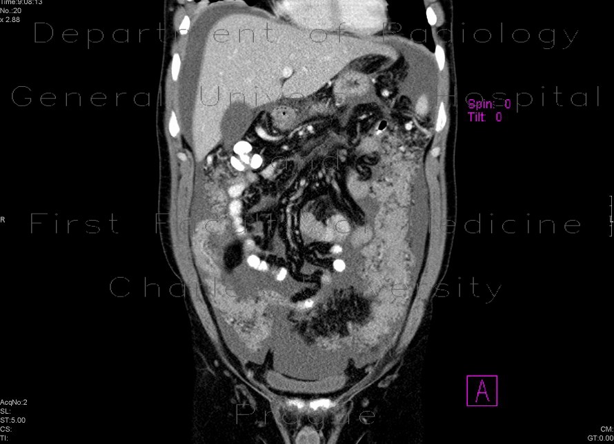 Carcinosis of mesentery