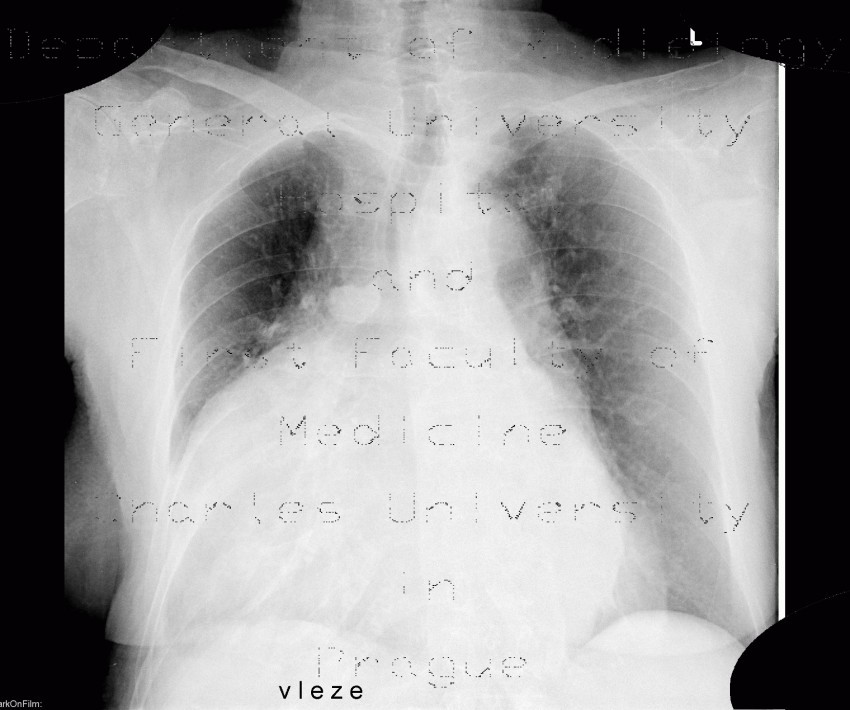 Cardiomegally, azygous vein