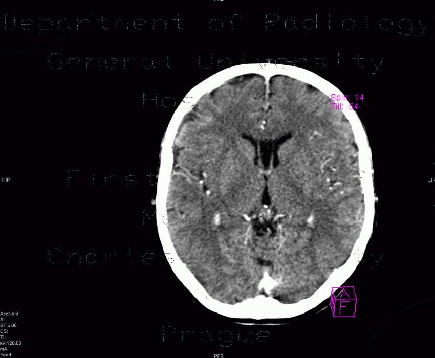 Cavum septi pellucidi
