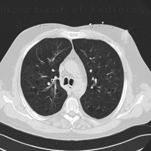 Centrilobular emphysema