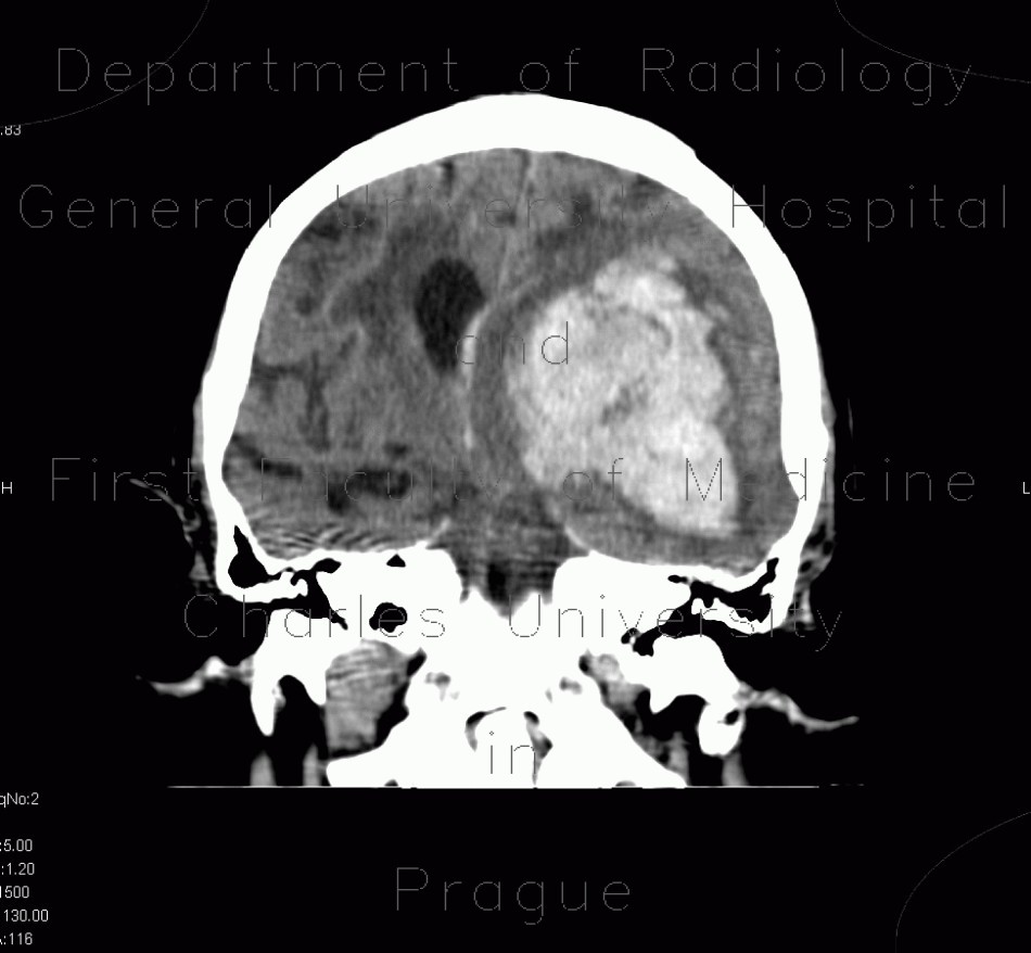 Cerebral hemorrhage, hypertonic hemorrhage, hemocephalus, subfalcine herniation, descendent transtentorial herniation