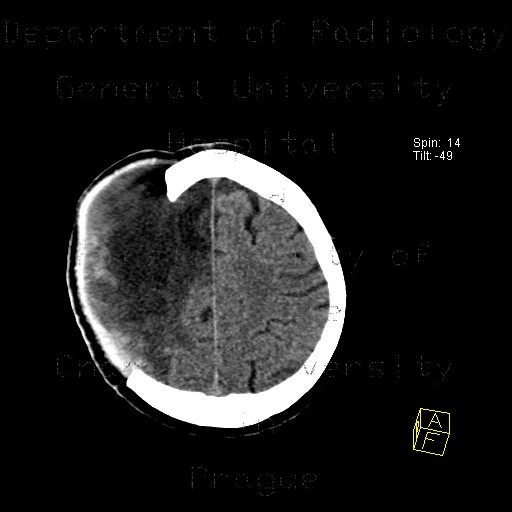 Cerebral ischemia, craniotomy, subarachnoid hemorrhage