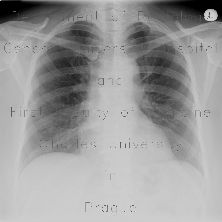 Cervical rib, compression of subclavian vein, trombosis of subclavian vein