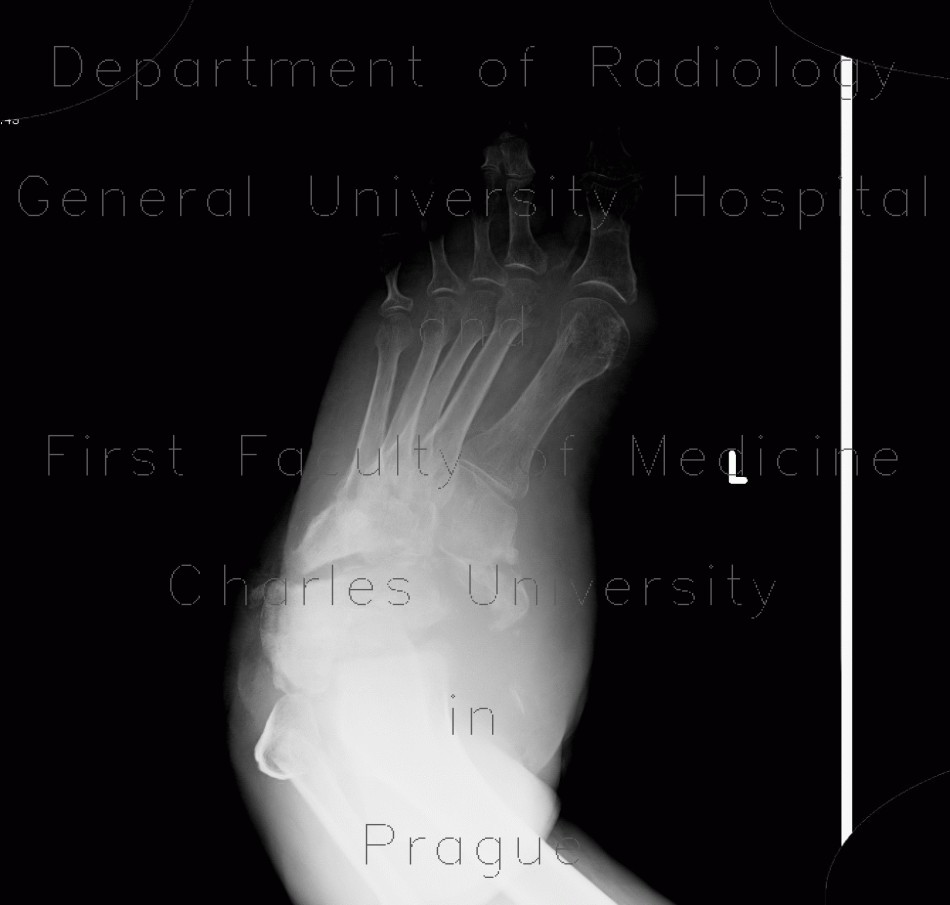 Charcot arthropathy, neuropathic osteoarthropathy, Charcot joint