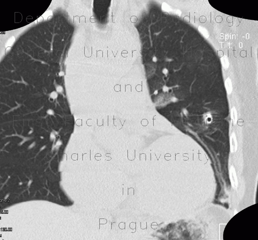 Chest tube, pleural drain