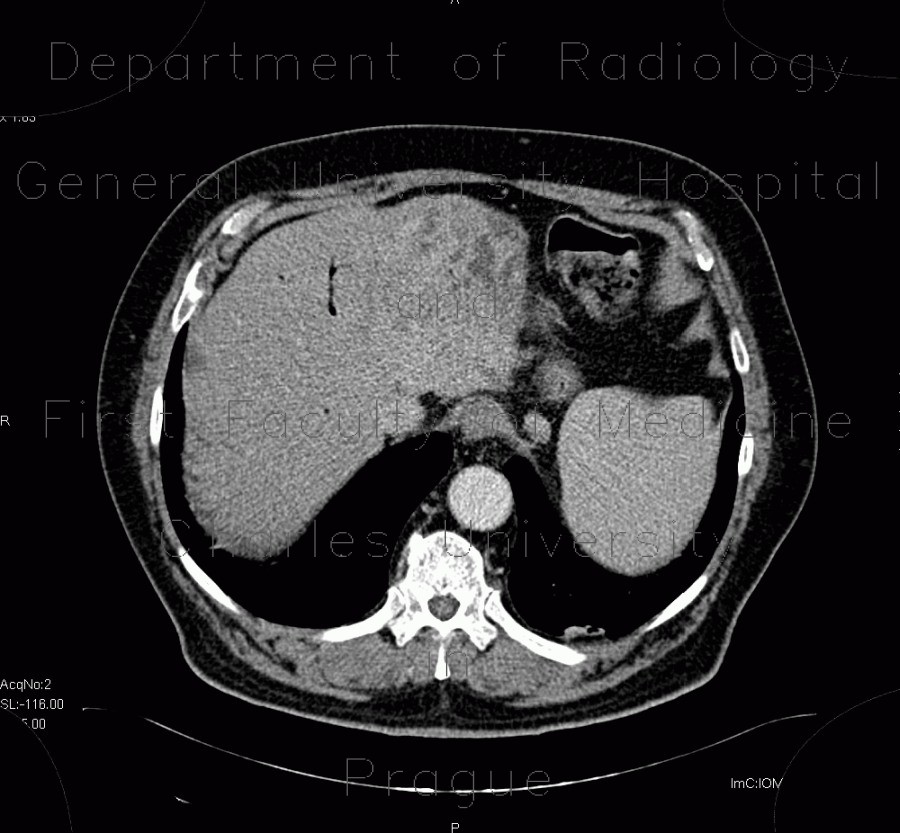 Cholangiocellular carcinoma of liver, dilation of intrahepatic ducts
