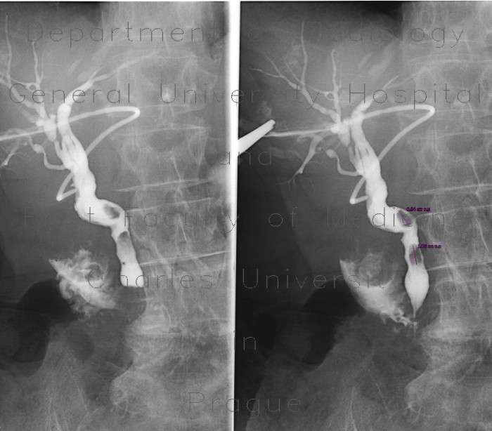 Cholangiography, T-drain, choledocholithiasis