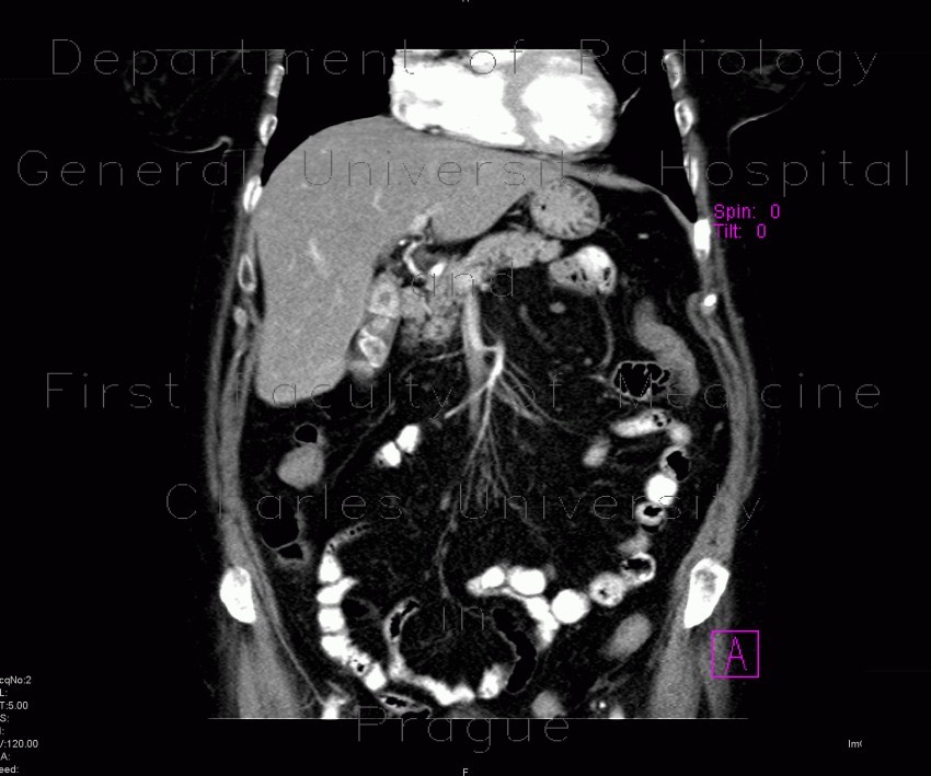 Cholecystolithiasis on CT