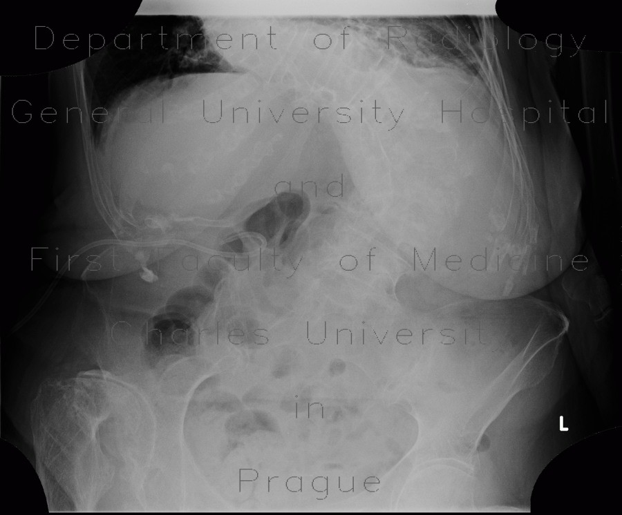 Cholecystostomy, acute cholecystitis