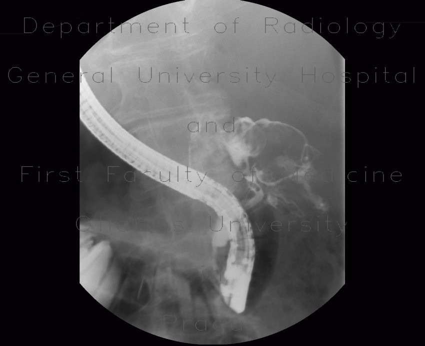 Choledochal diverticulum, ERCP