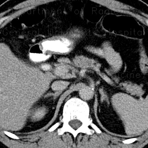 Choledocholithiasis, gallstones